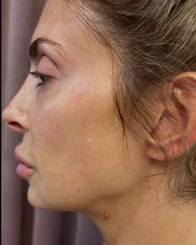 Loose skin along the jawline and neck before Morpheus8