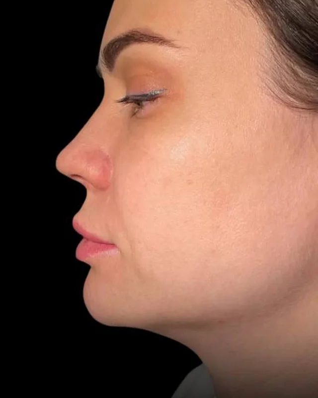 Smoother, firmer lower face after Morpheus8 at Pari Med Spa