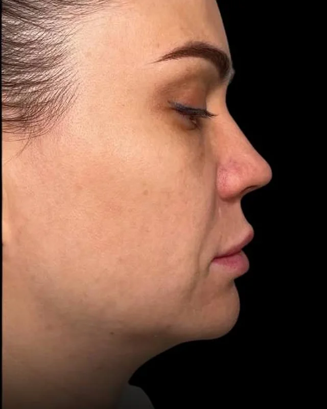 Skin texture and lower face laxity in profile before Morpheus8