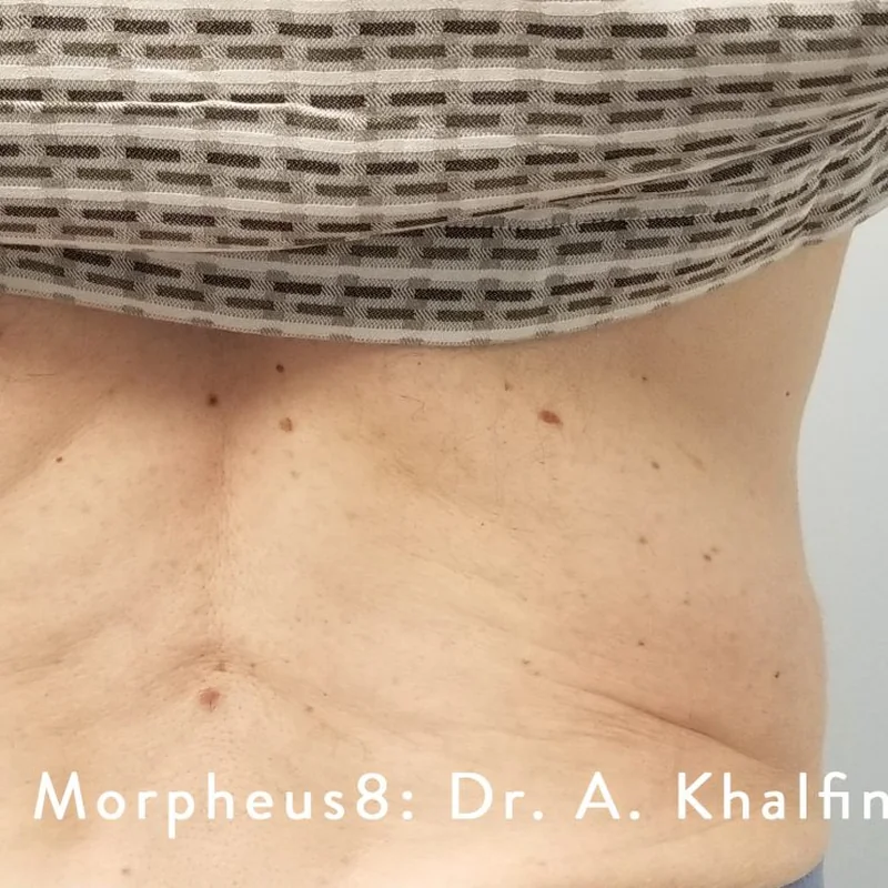 Lower back skin after Morpheus8 Body