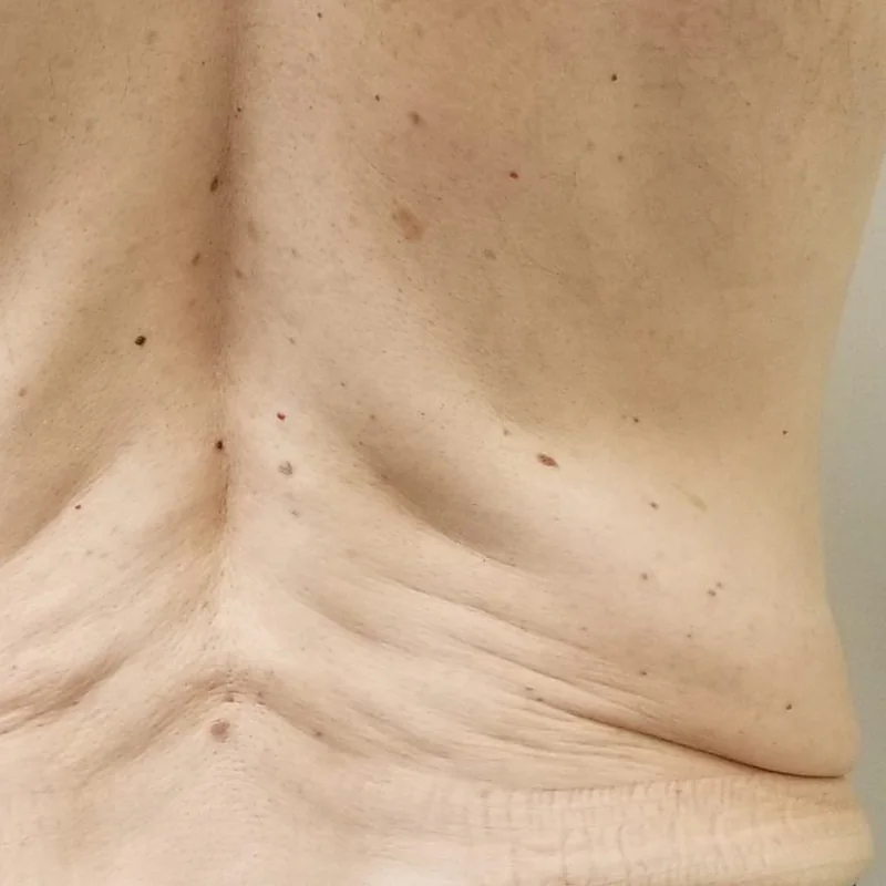 Lower back skin before Morpheus8 Body
