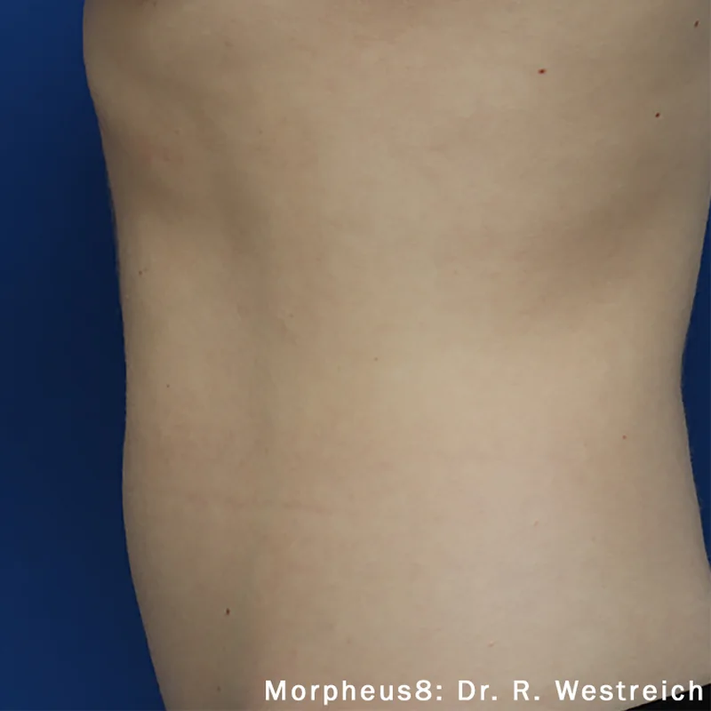 The flank and waist after Morpheus8 Body