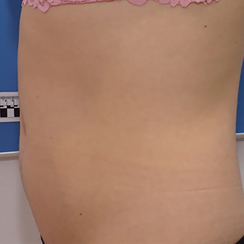 The flank and waist before Morpheus8 Body