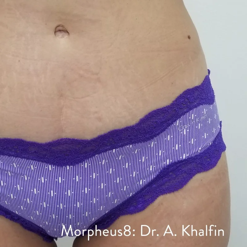 Stomach skin and stretch marks after Morpheus8 Body