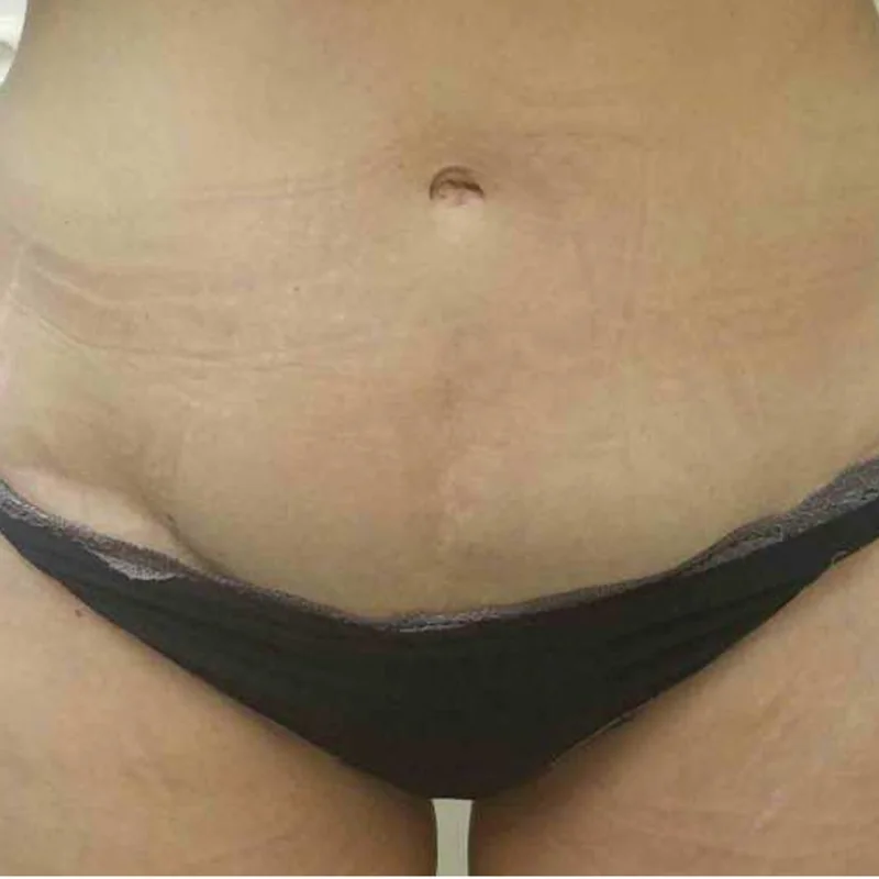 Stomach skin and stretch marks before Morpheus8 Body