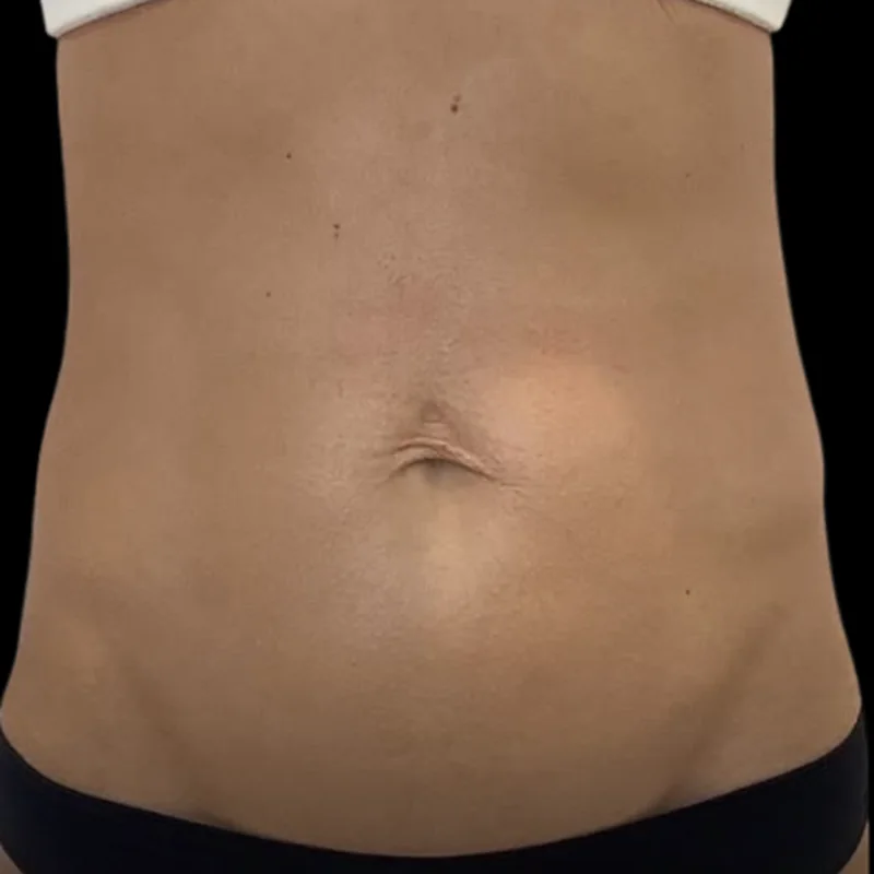 Loose, crepey stomach skin after Morpheus8 Body