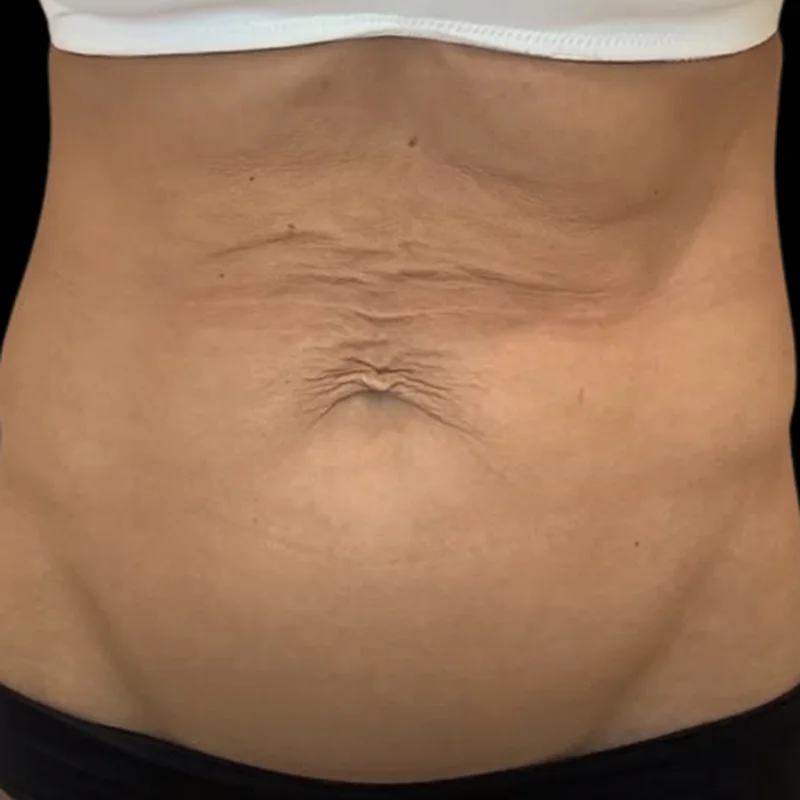 Loose, crepey stomach skin before Morpheus8 Body