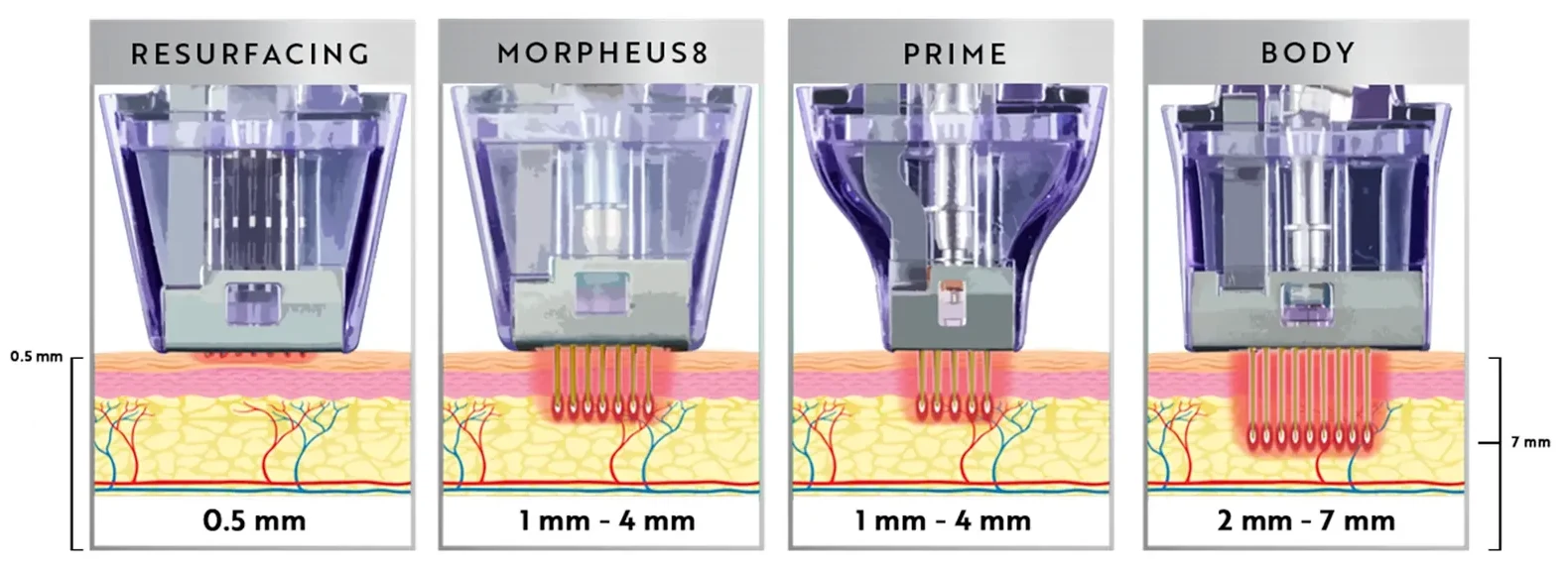 Morpheus8 tip depths: Resurfacing 0.5 mm, Morpheus8 and Prime 1 to 4 mm, and Body 2 to 7 mm