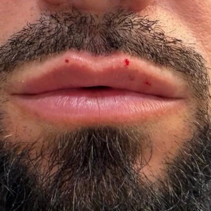 Fuller, natural-looking lips after lip filler by Dr. Parvina