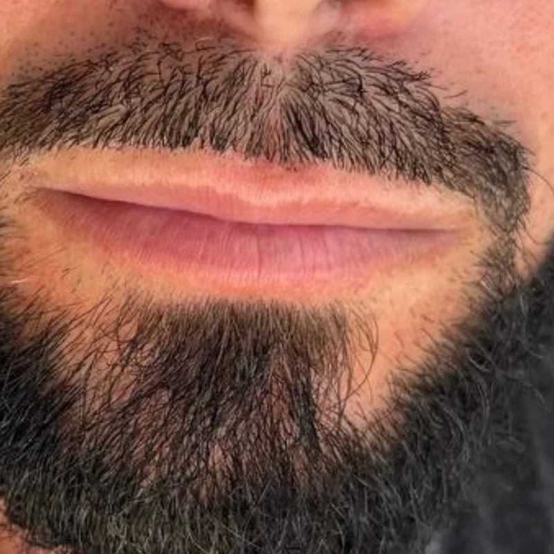 Thin lips before lip filler