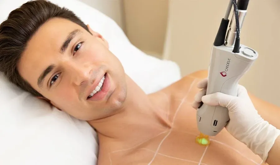 Candela laser hair removal