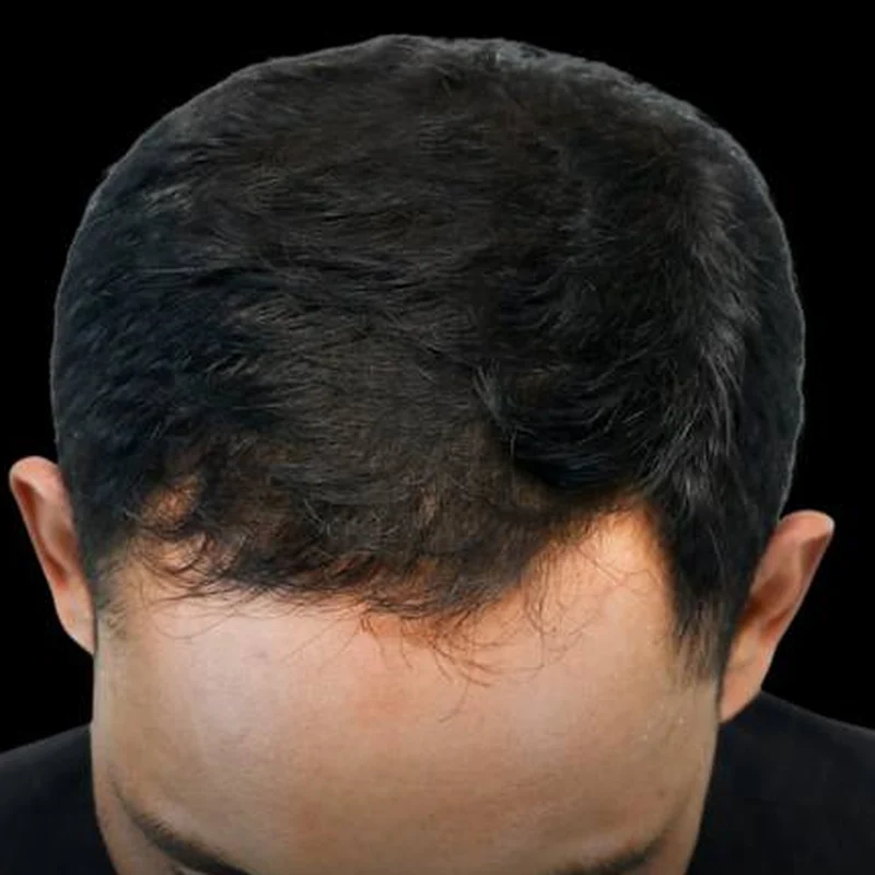 Fuller hair on the crown after PRP hair restoration at Pari Med Spa