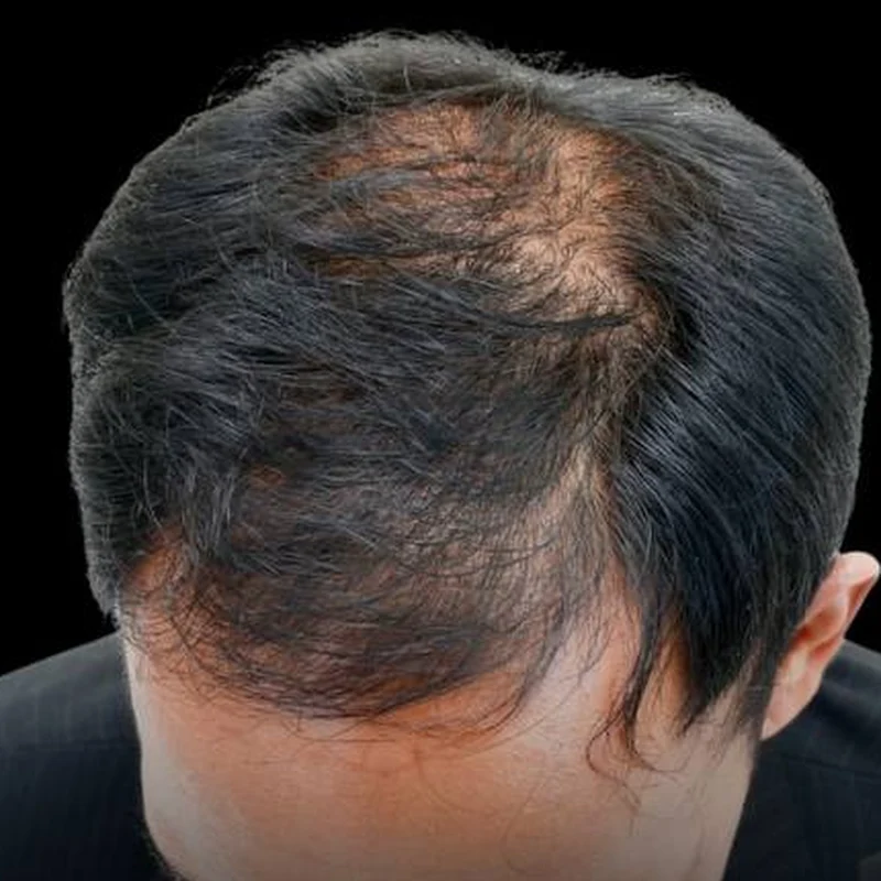 Thinning hair on the crown before PRP hair restoration