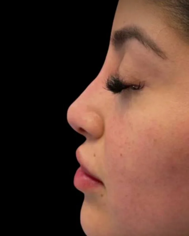 Refined nose profile after a non-surgical nose job at Pari Med Spa, client 1