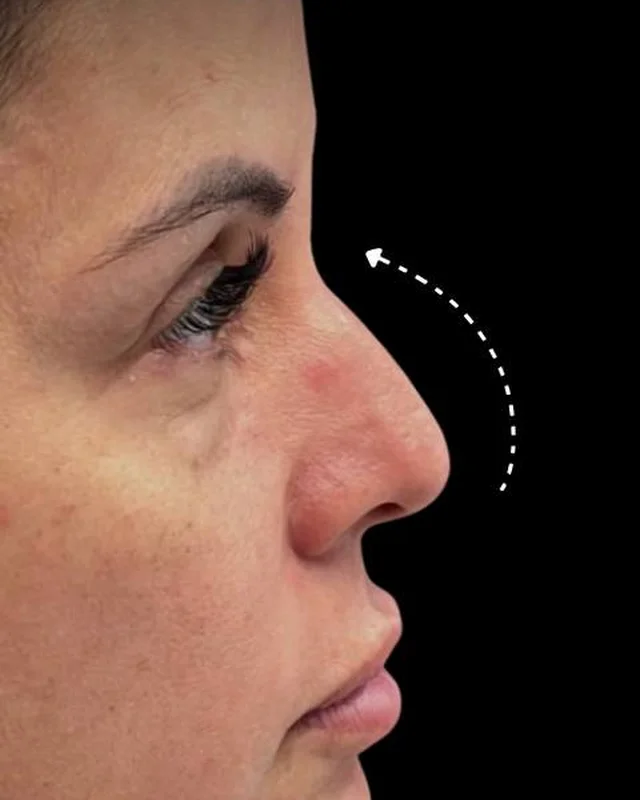 Nose profile before a non-surgical nose job, client 2