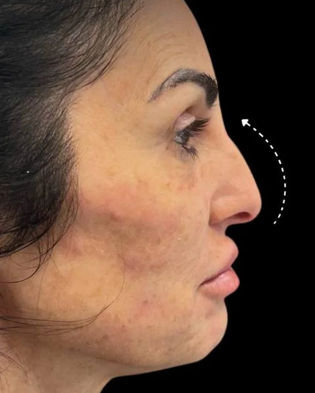 Nose profile before a non-surgical nose job, client 3