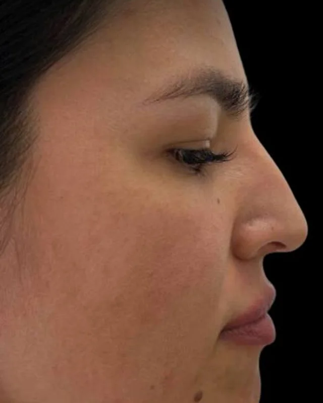 Nose profile before a non-surgical nose job, client 4