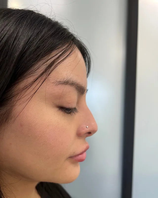 Refined nose profile after a non-surgical nose job at Pari Med Spa, client 5