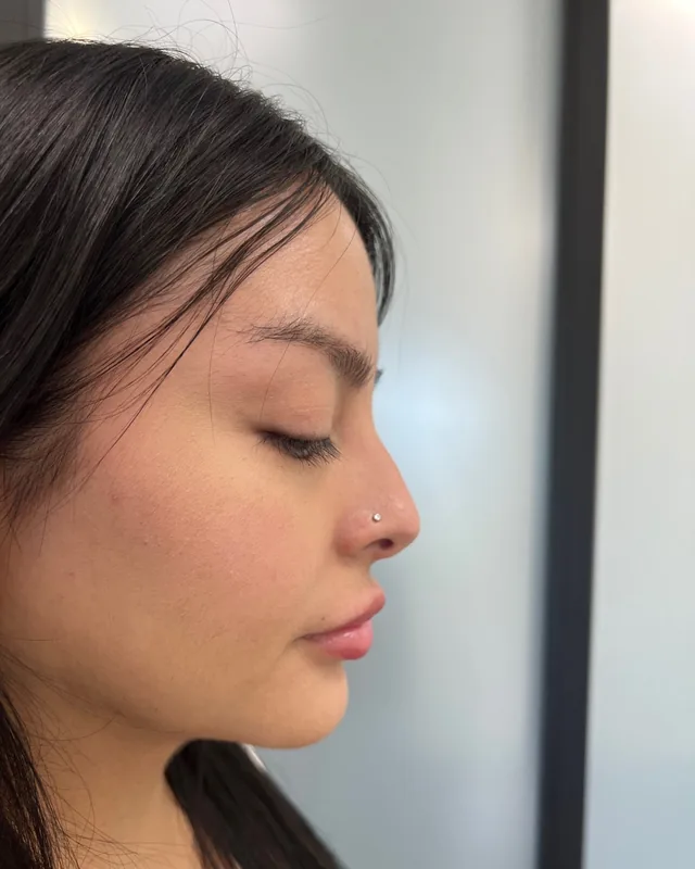 Nose profile before a non-surgical nose job, client 5