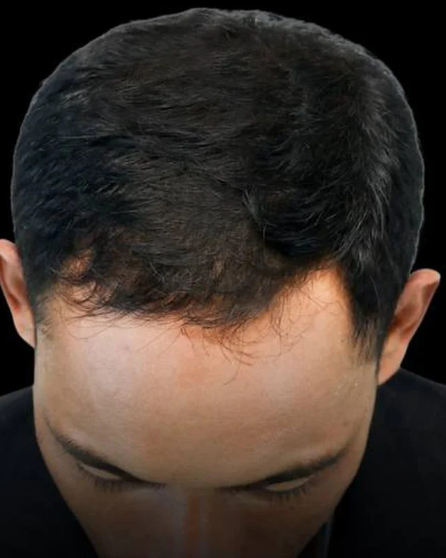 Fuller hair at the crown after PRP hair restoration at Pari Med Spa