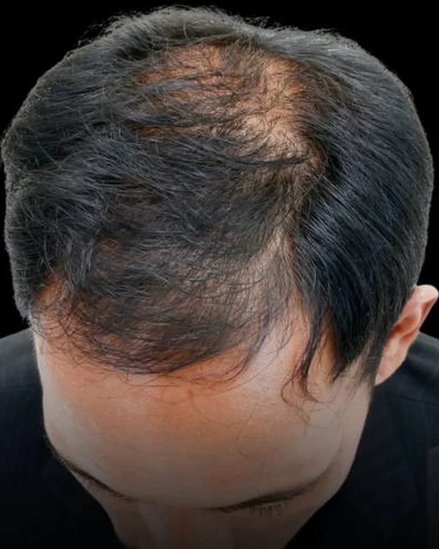 Thinning hair at the crown before PRP hair restoration
