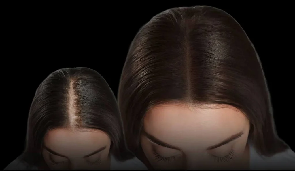 Widening part before PRP hair restoration, left, and a fuller part after treatment, right