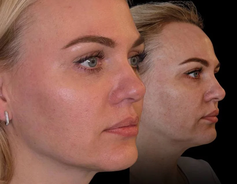 Profile showing glowing skin after treatment in front and the same client before treatment behind