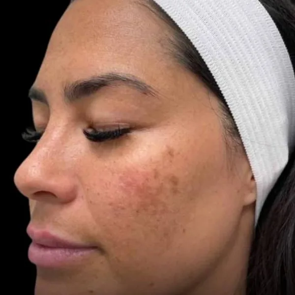 Sun spots and uneven tone on the cheek before a chemical peel