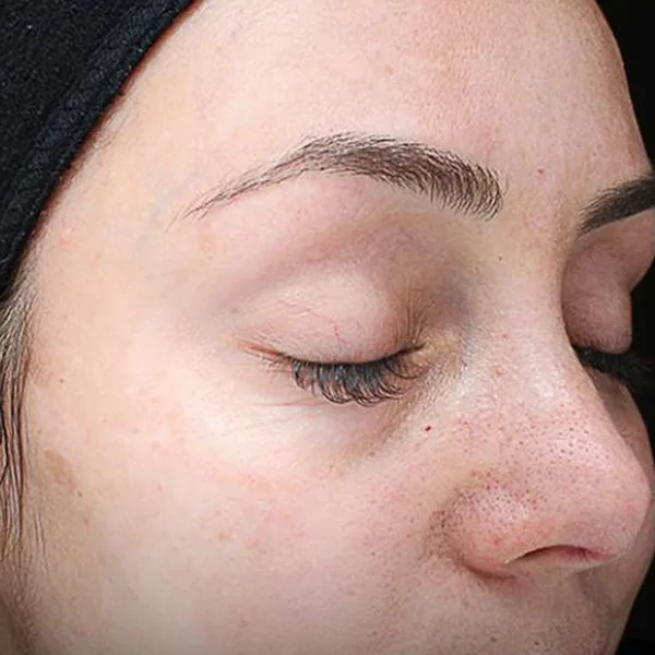Faded pigmentation and brighter skin after a chemical peel at Pari Med Spa