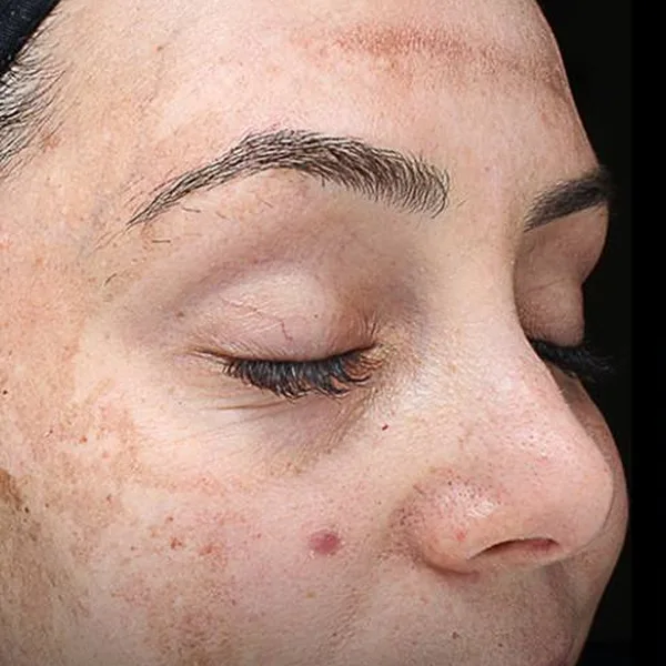 Melasma and dark patches on the forehead and cheek before a chemical peel