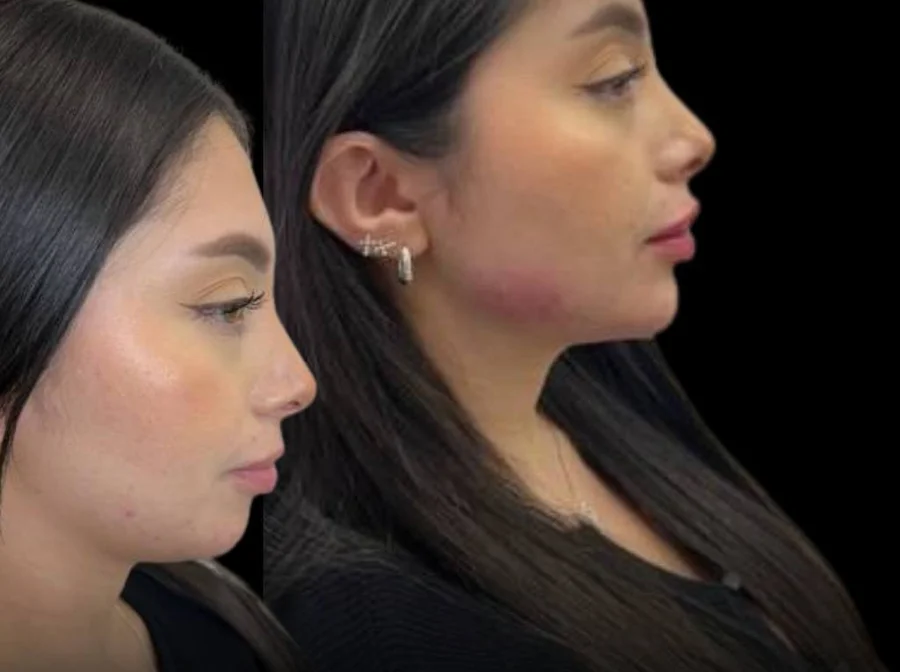 Profile before, left, and a more balanced jawline and chin after, right