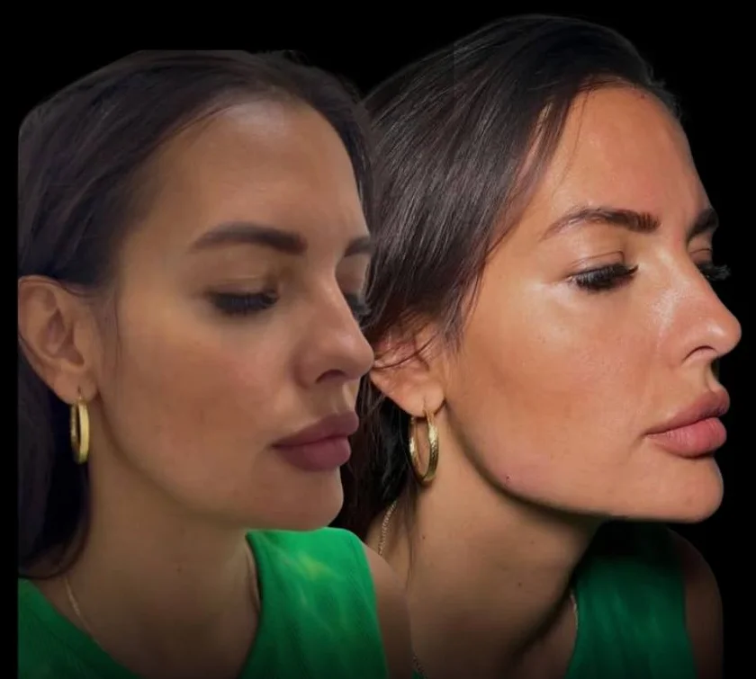 Lower face before, left, and a lifted, contoured face after, right