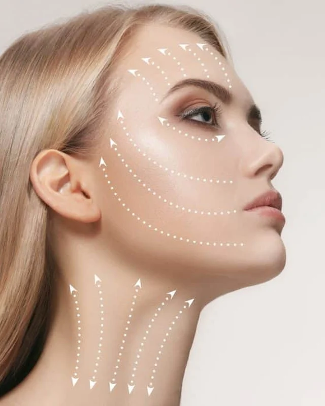 Lift lines along the jawline and neck showing V-Lift contouring